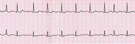 New 2019 American College of Cardiology/American Heart Association ...