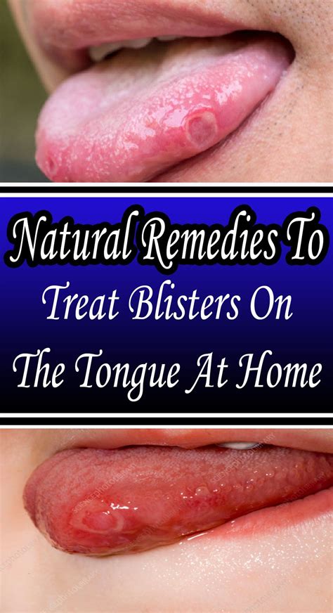 #Characteristic Remedies To Treat Blisters On The Tongue At Home#Health | Remedies, Natural ...