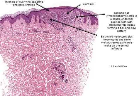 Dermatopathology Made Simple - Inflammatory: Lichenoid / Vacuolar Reaction Pattern