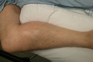 Clinical picture of right leg postero-medial swelling of the calf with ...