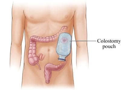 Colostomy surgery Mumbai| Laparoscopic colostomy India