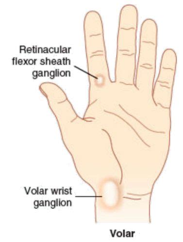 Synovial Cyst Finger Joint