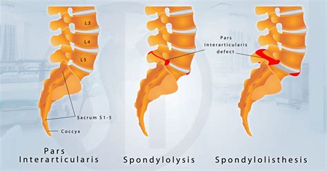 Spondylolisthesis Treatment at Spine One | Denver Spine Pain Specialists