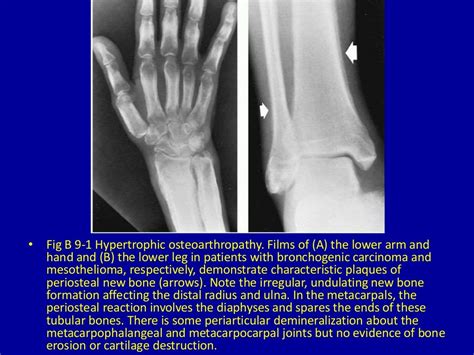 9 widespread or generalized periosteal reaction