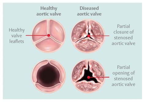 Aortic Stenosis Anatomy Diagnosis Treatment - The Valve Clinic