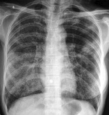 This X-ray shows the ground-glass opacity composed by diffuse ...