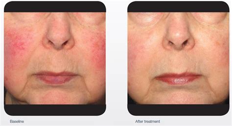 IPL/laser for redness & broken capillaries – QSD