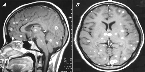 Multiple ring enhancing lesions in brain MRI of a patient with AIDS ...