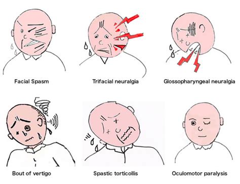 Cranial Nerve Surgery Disease：Nerve vascular compression syndrome | Treatment of disorder ...