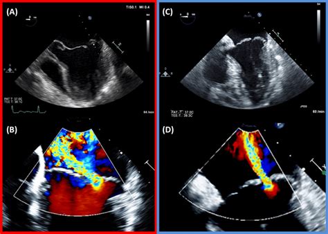 Echocardiographic images of the two different patterns of Barlow´s ...