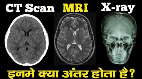 Difference Between MRI CT Scan And X-ray in Hindi | MRI Scan Kaise Hota ...