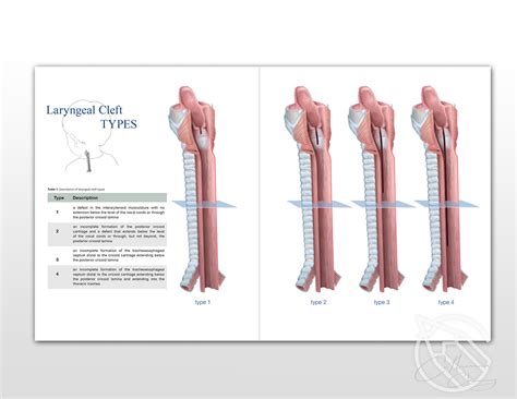 Introduction to laryngeal clefts on Behance