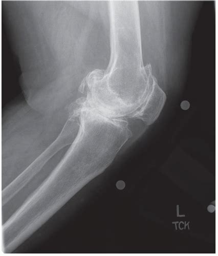 Flexion Contracture | Musculoskeletal Key