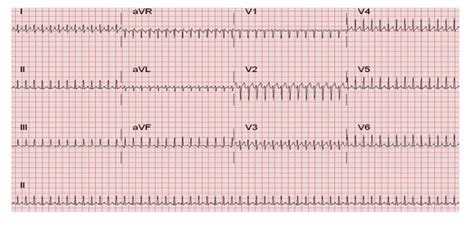 Supraventricular Tachycardia Rhythm Strip