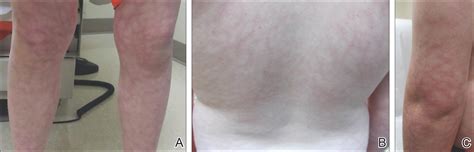 Amantadine-Induced Livedo Reticularis in a Child Treated Off Label for Neurobehavioral Disorders ...