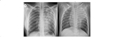 Chest X-ray studies showing extensive TB-lung involvement in both the... | Download Scientific ...