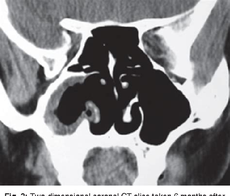 Figure 3 from Maxillary Sinus Osteoma: A Rare Cause of Headache | Semantic Scholar