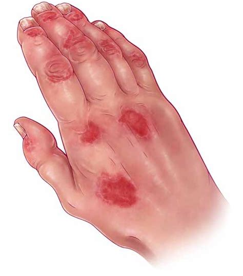 A Rash of Evidence: Evaluating & Treating Psoriatic Arthritis - The Rheumatologist