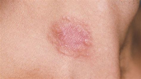 Leukemia Rash Pictures, Signs, and Symptoms