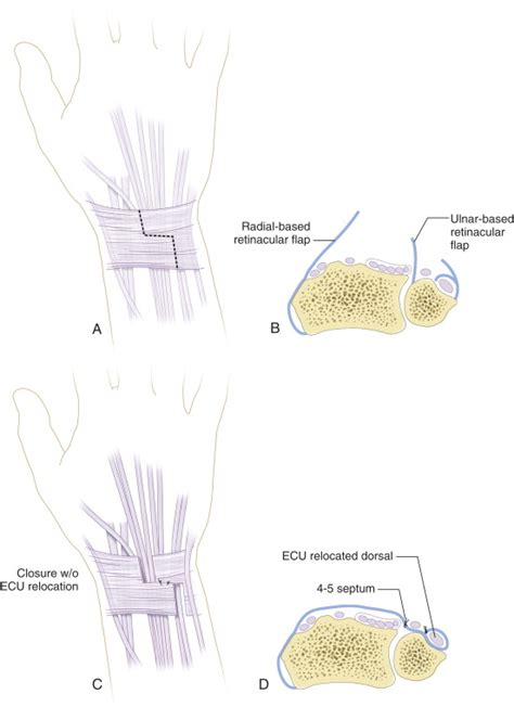 Rheumatoid Arthritis of the Wrist | Musculoskeletal Key