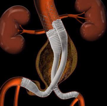 Lombard Medical acquires EVAR stent graft developer Altura Medical ...