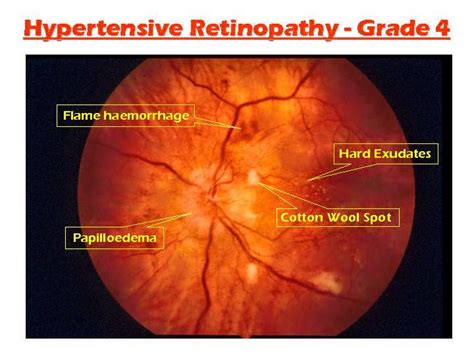 Emergency Medicine: Diabetic & Hypertensive Retinopathy