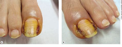 Figure 1 from Nail Pyogenic Granuloma following Treatment with ...