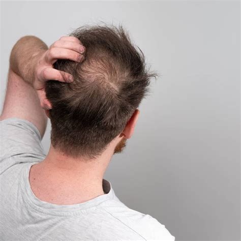 Male Pattern Baldness Do You Have These 4 Early Warning