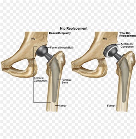 Hemiarthroplasty Vs Total Hip Replacement PNG Transparent With Clear ...