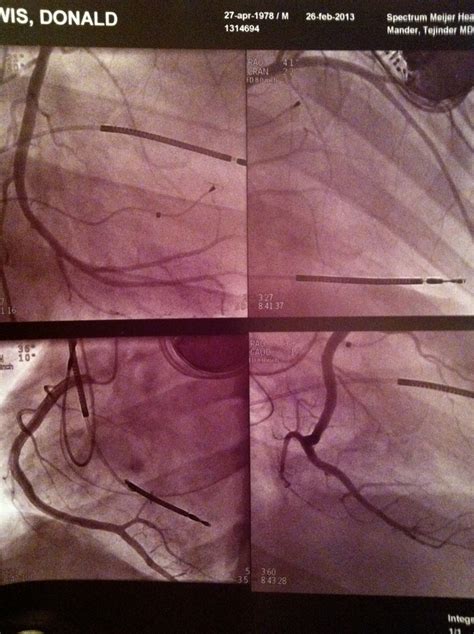 Heart Cath Procedure | Cardiac Cath- RCIS | Pinterest