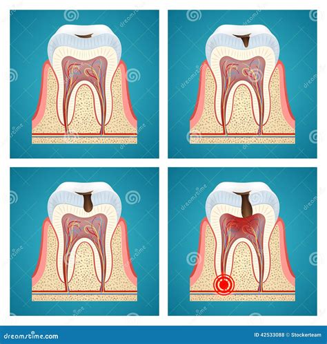 The Stages Of Caries On The Molar - 3D Rendering Stock Photography | CartoonDealer.com #124334618