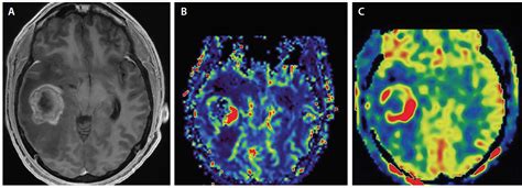 Brain Tumor Imaging - Practical Neurology