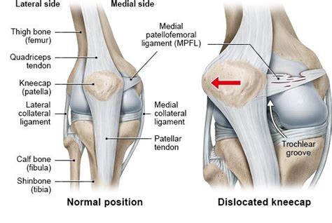 Dislocated kneecap | informedhealth.org