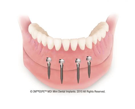 Mini-implant overdenture | Rocky Mount NC DentureCare & Implants