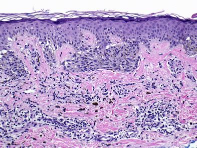 Dysplastic Nevi - Surgical Pathology Clinics