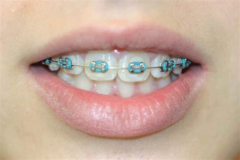 Light Blue Braces For You | Braces colors, Light blue braces, Braces teeth colors