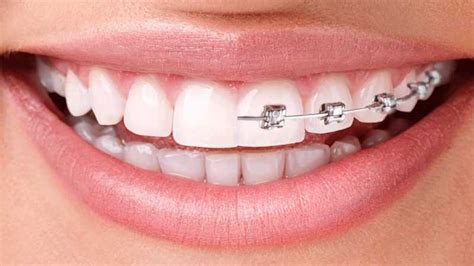 Braces VS Invisalign: Which One is Better For You? - Paradise Smiles