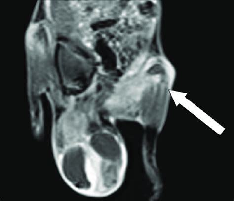 Contrast T1 MRI showing significant contrast enhancement MRI: Magnetic... | Download Scientific ...