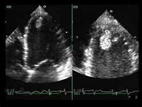 Rivaroxaban For Lv Thrombus | IUCN Water