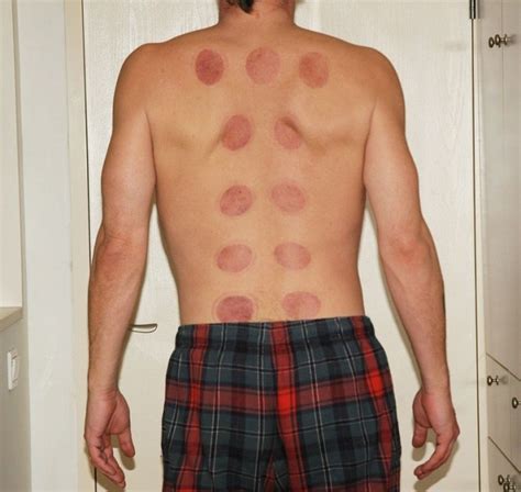 Fire Cupping: What You Need to Know - Santa Barbara Herb Clinic