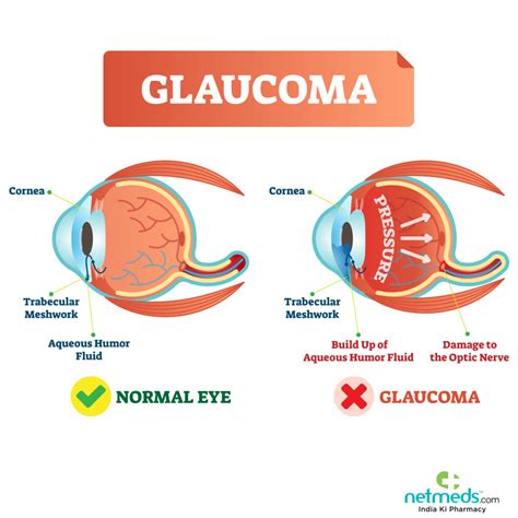 Glaucoma: Causes, Symptoms And Treatment | Netmeds