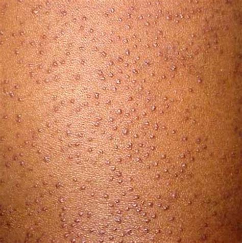 Keratosis Pilaris - Pictures, Treatment, Symptoms and Causes | HubPages