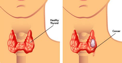 Thyroid Disorder | Types, Symptoms, Causes & Prevention