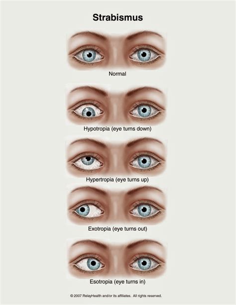 Everything You Need To Know About Cover Testing - Eyedolatry