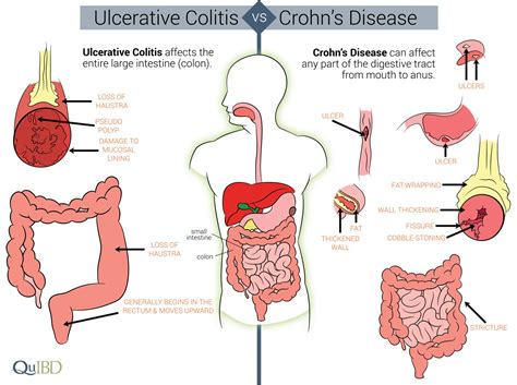 Crohns vs Ulcerative Colitis 2 — Edureach101