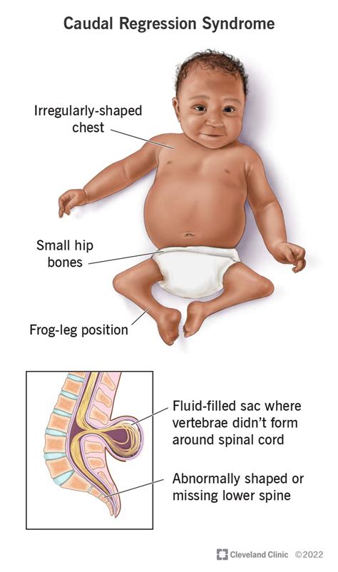 Case Caudal Dysplasia With Agenesis Of Lower Limbs Maternal | My XXX ...