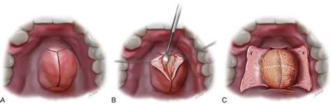 Torus Mandibularis Removal