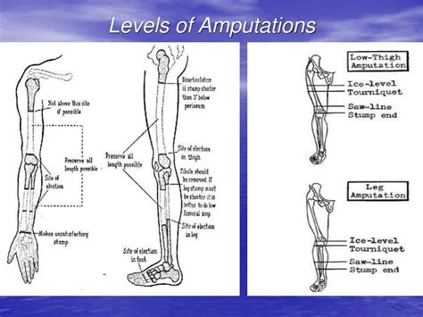 Levels Of Lower Limb Amputation