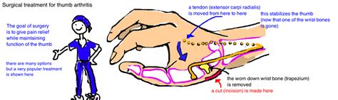 Hand - Thumb Arthritis — Bone Talks