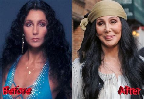 Cher Plastic Surgery : Just Too Much Of Procedures